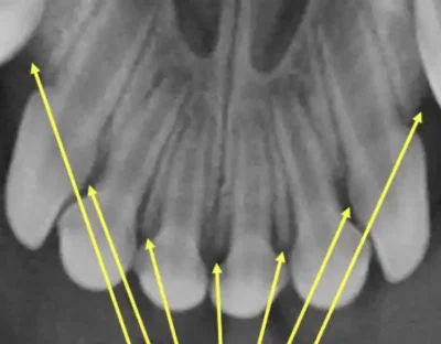 Normal Healthy Teeth Radiograph