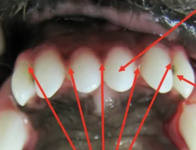 Normal Teeth