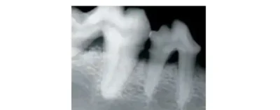 STAGE 3 RADIOGRAPH