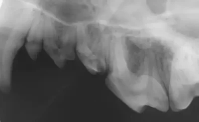 Stage 1 radiograph