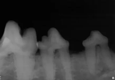 Stage 2 radiographs