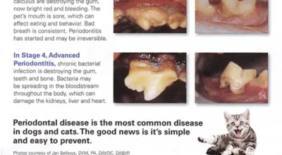 Teeth stage 4 advanced periodontal disease