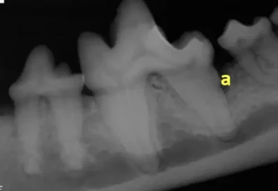 This is Grade 2 with a periodontal pocket.